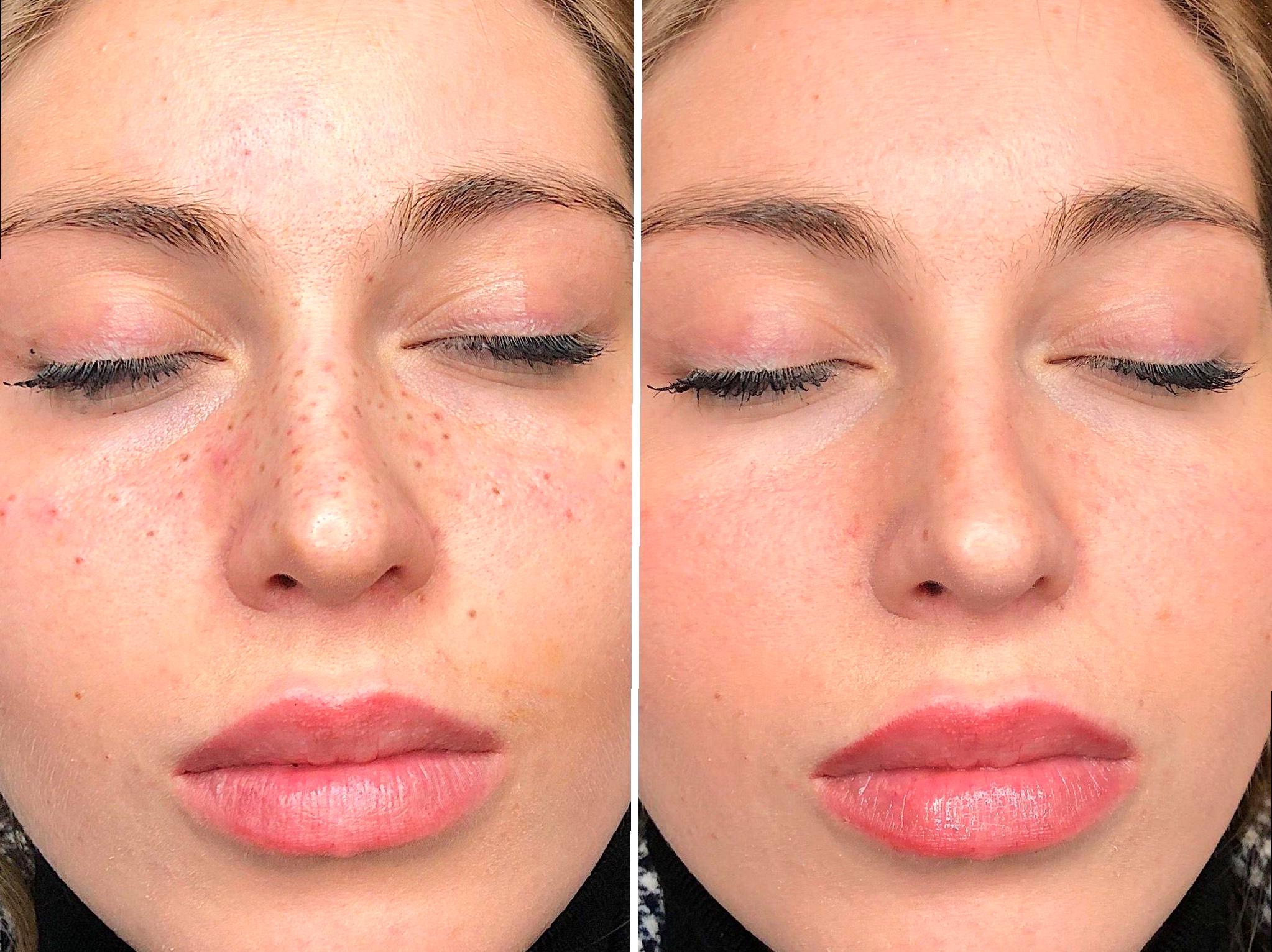 Tattoo Freckles: A Trendy Way to Add Natural-Looking Freckles