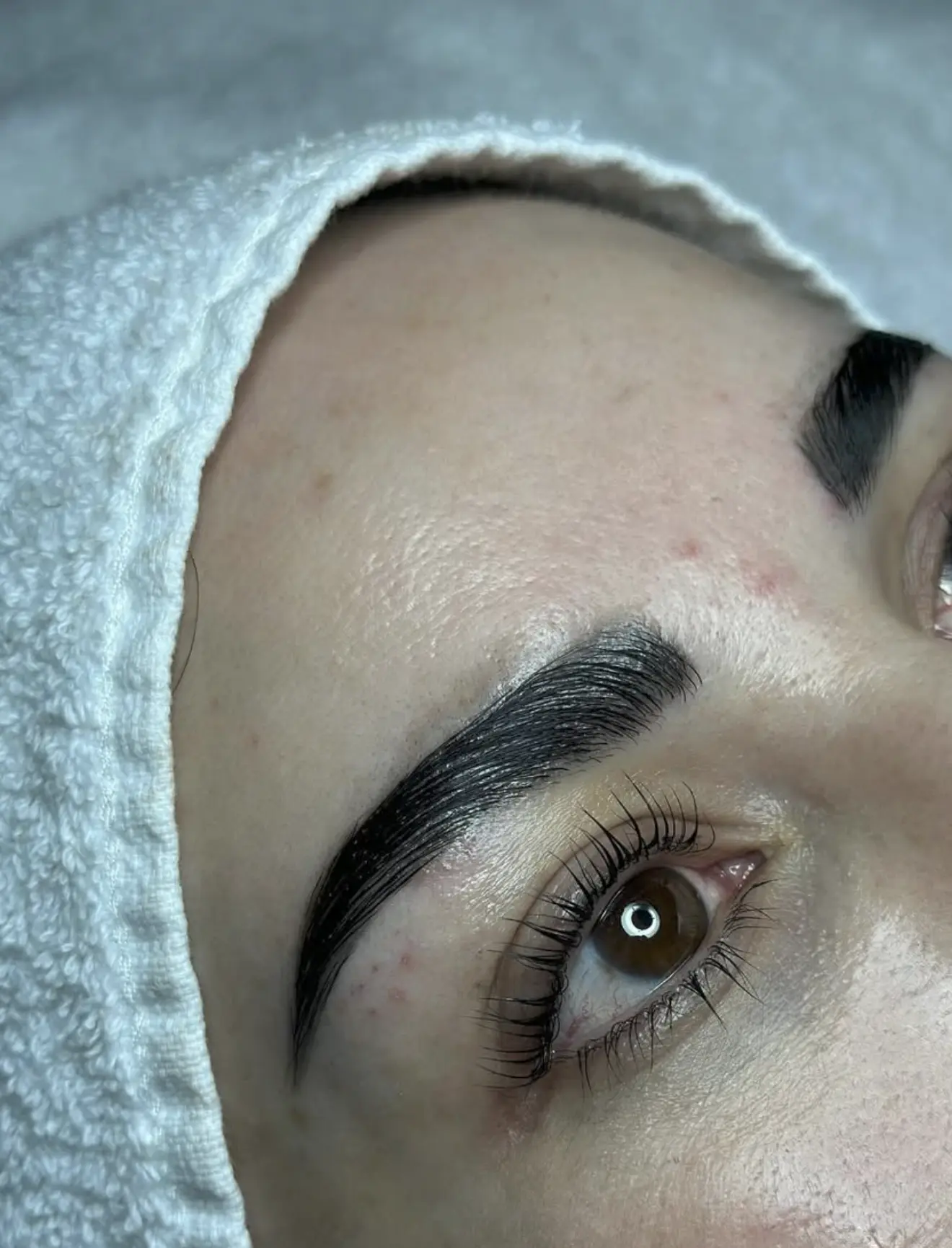 botox brow lift for hooded eyes