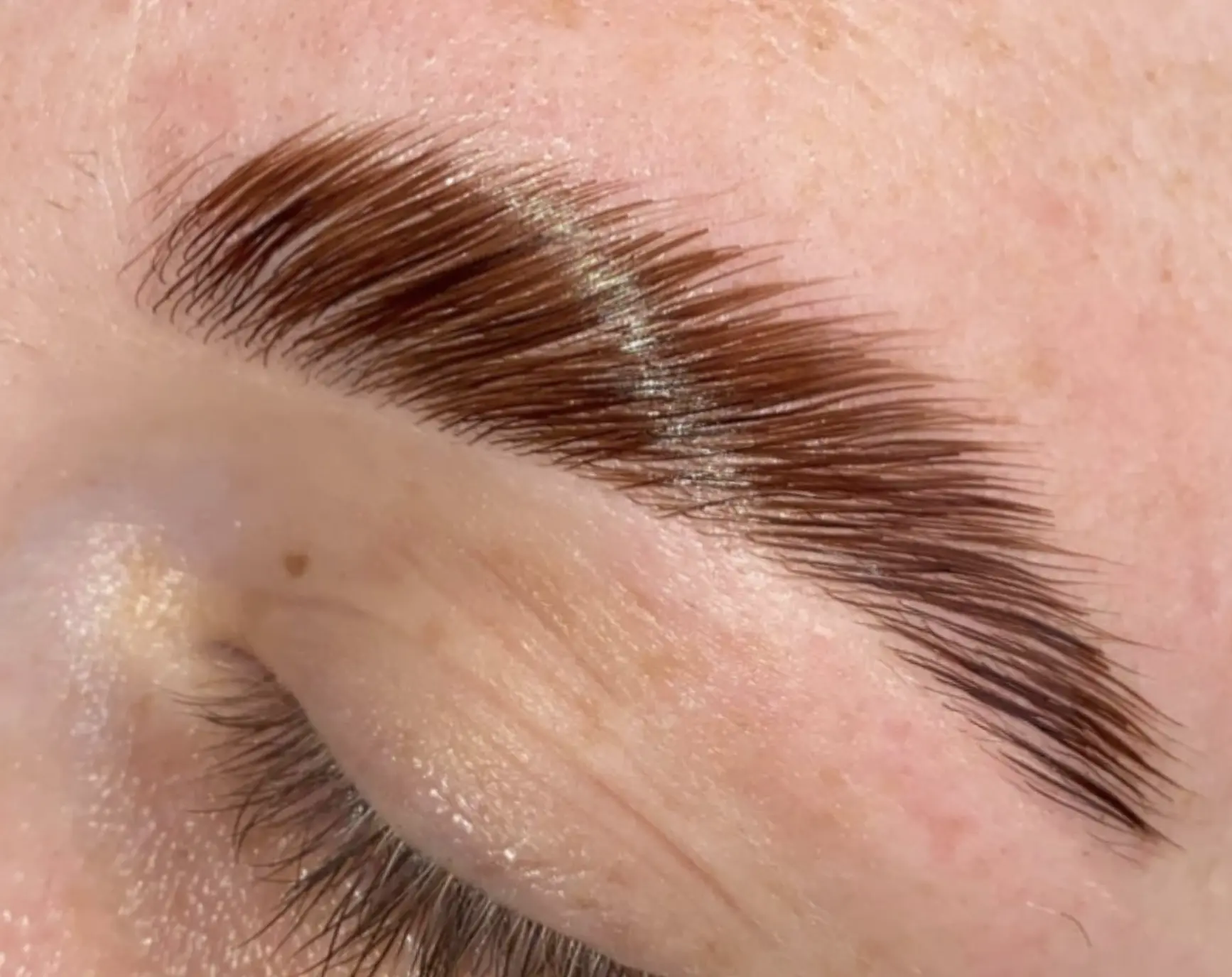 botox brow lift gone wrong