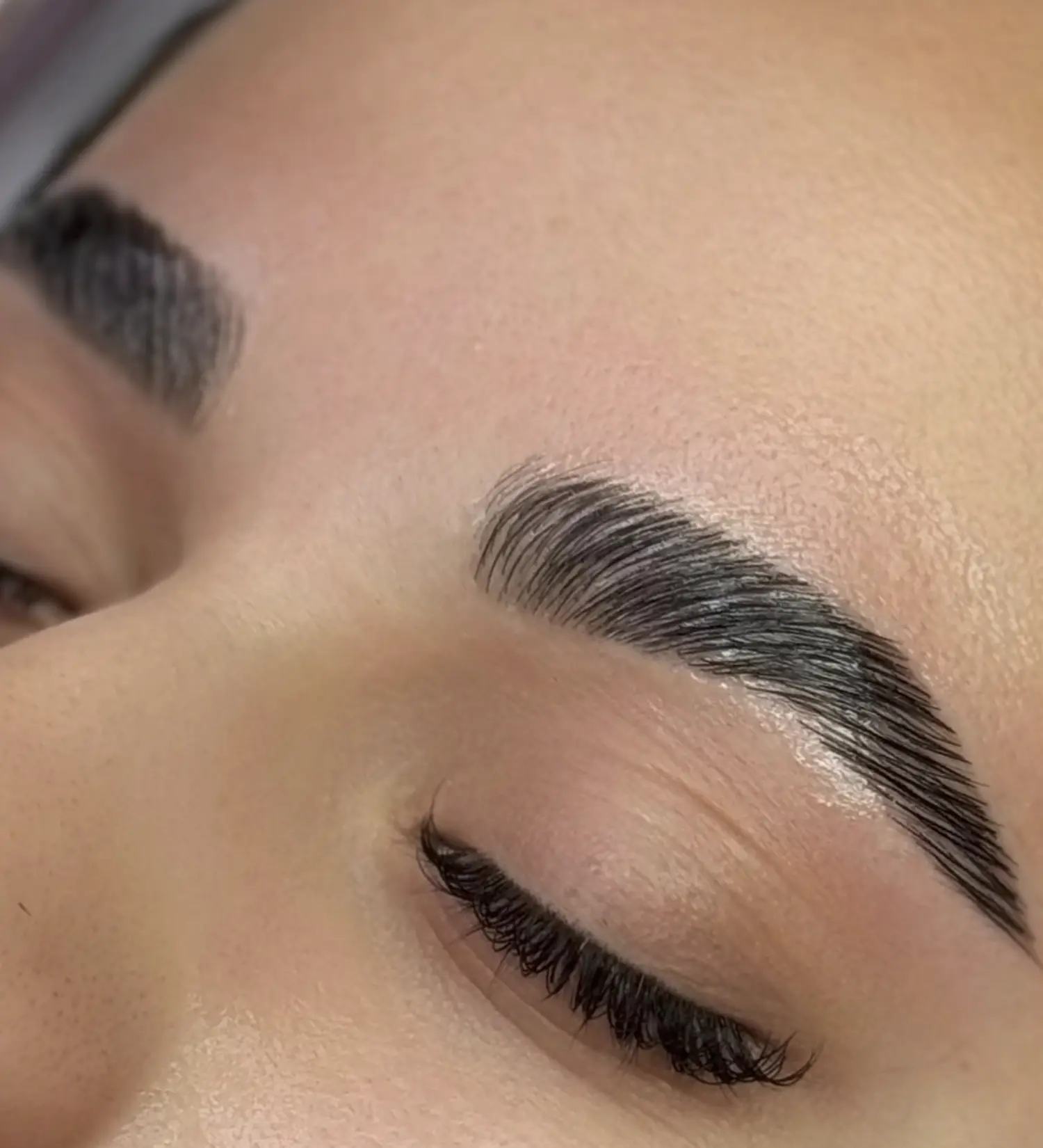 botox brow lift hooded eyes