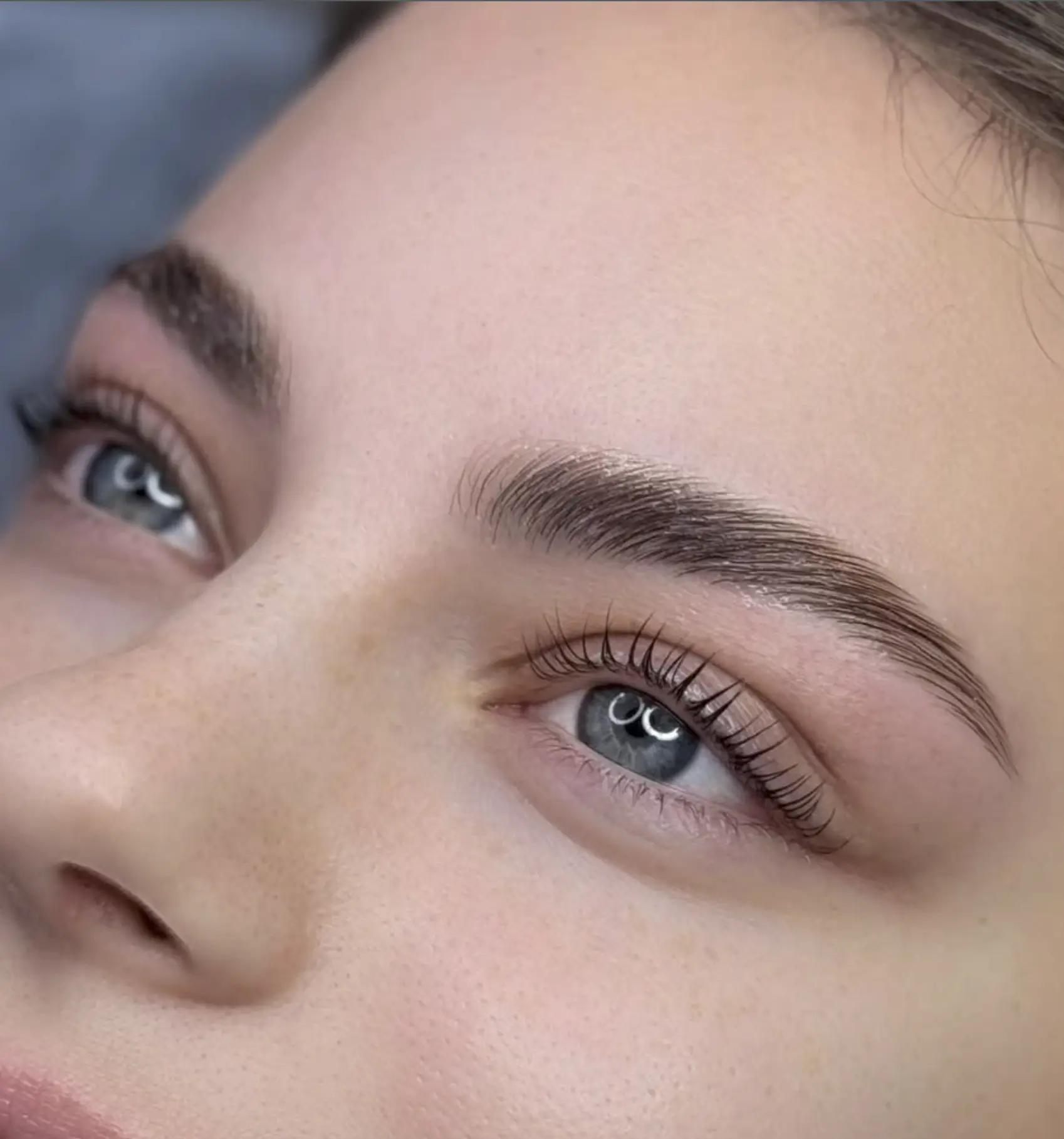 botox brow lift injection sites