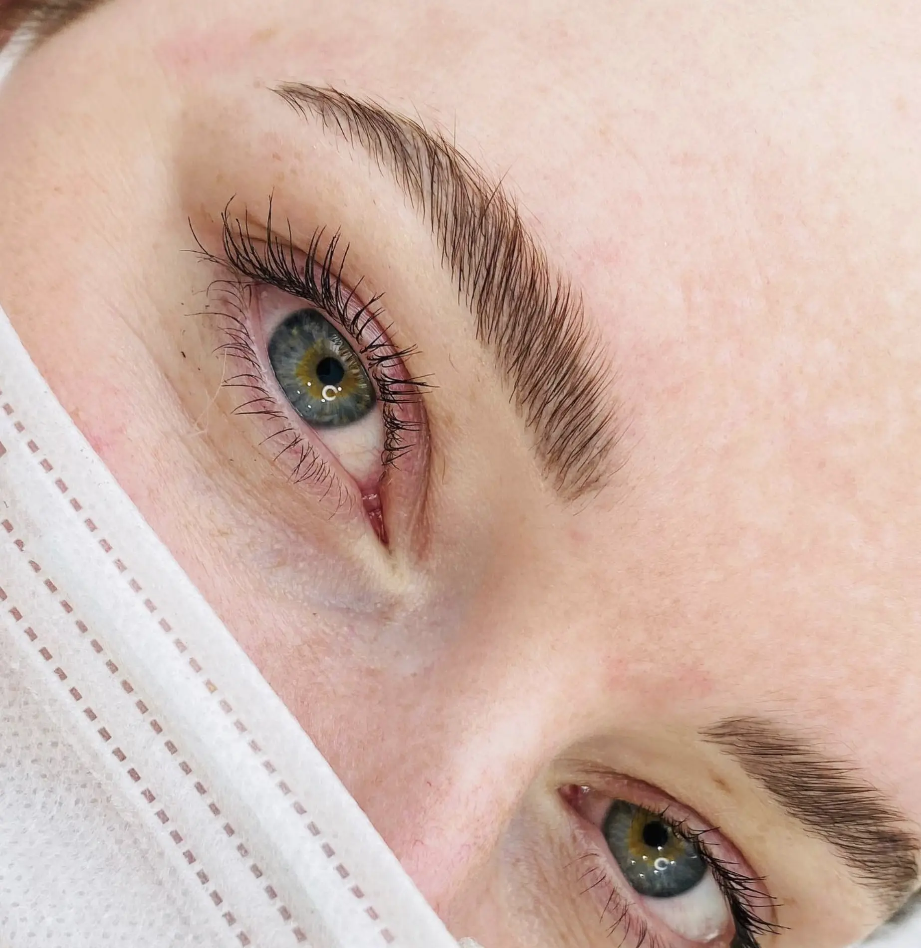 botox brow lift results