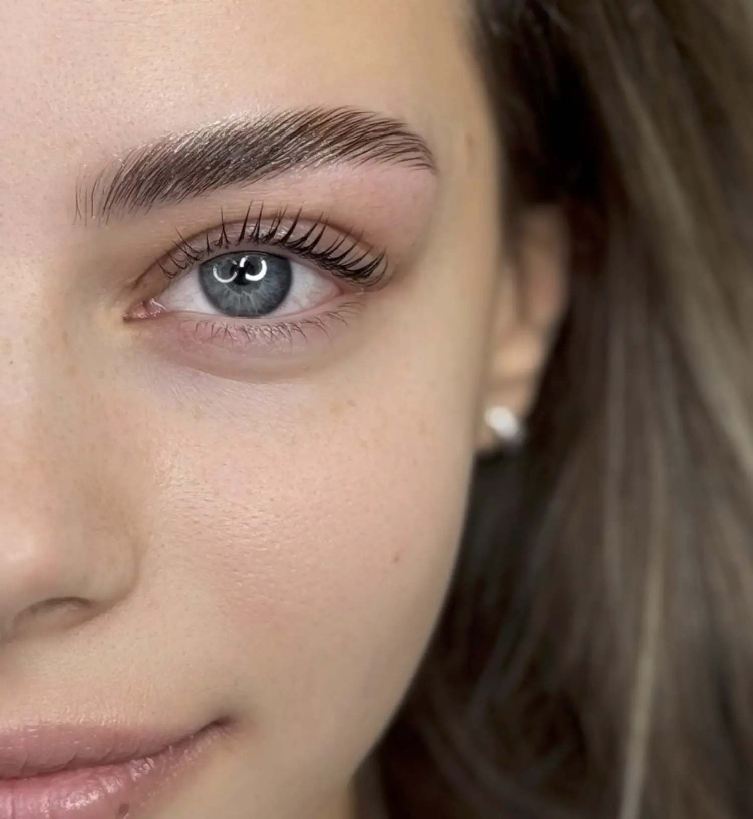 brow botox before and after