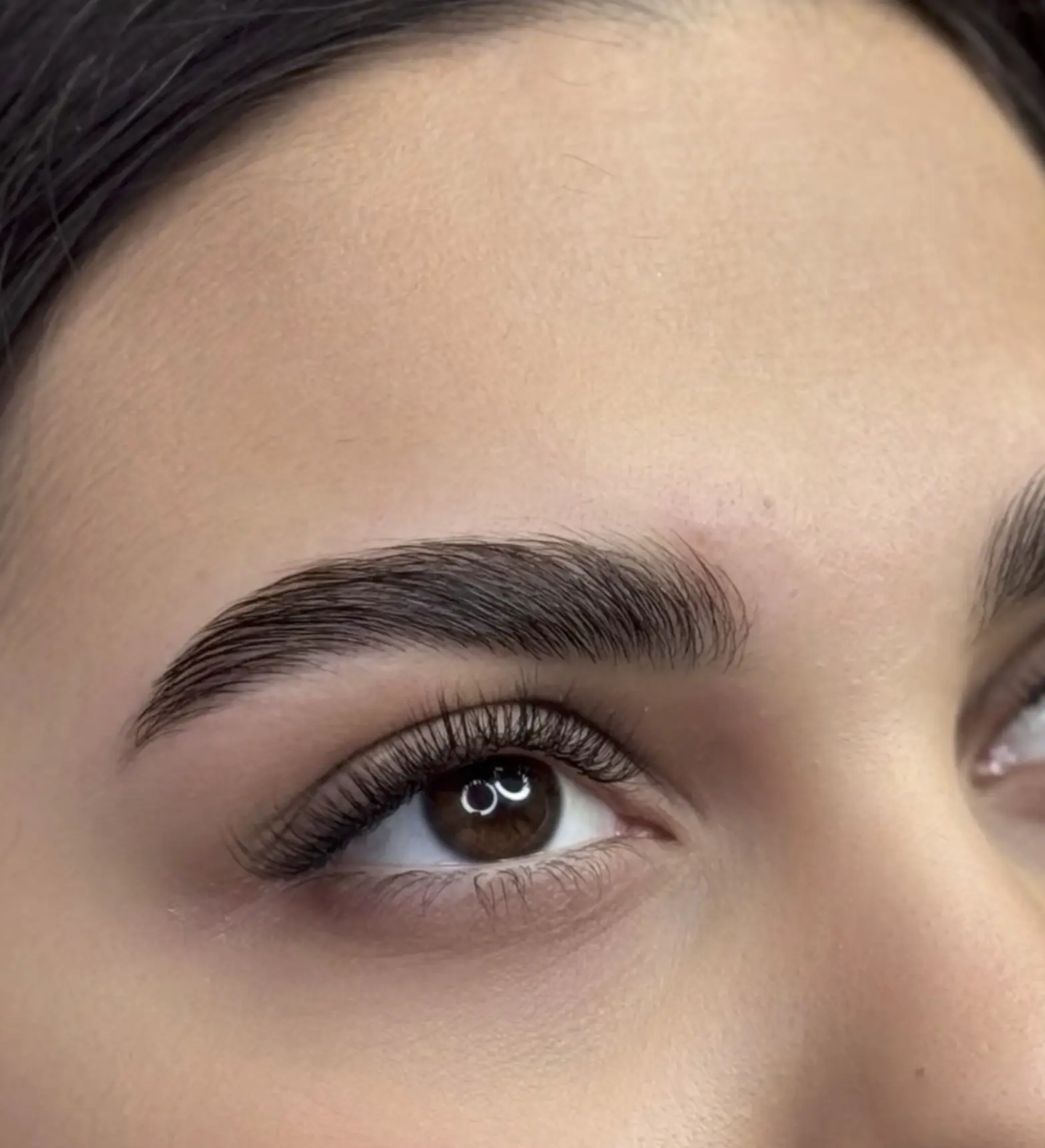 brow botox