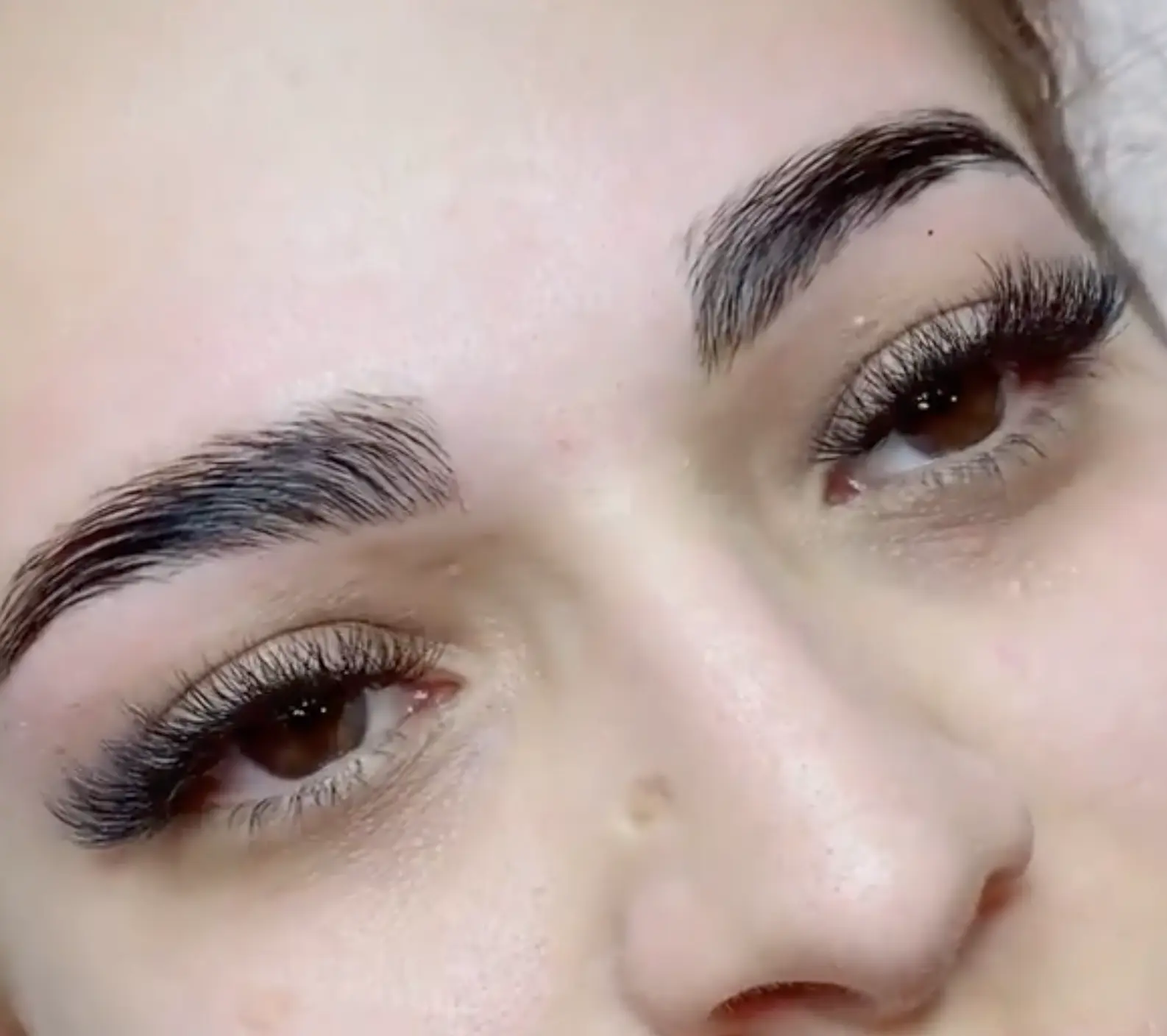 brow droop botox