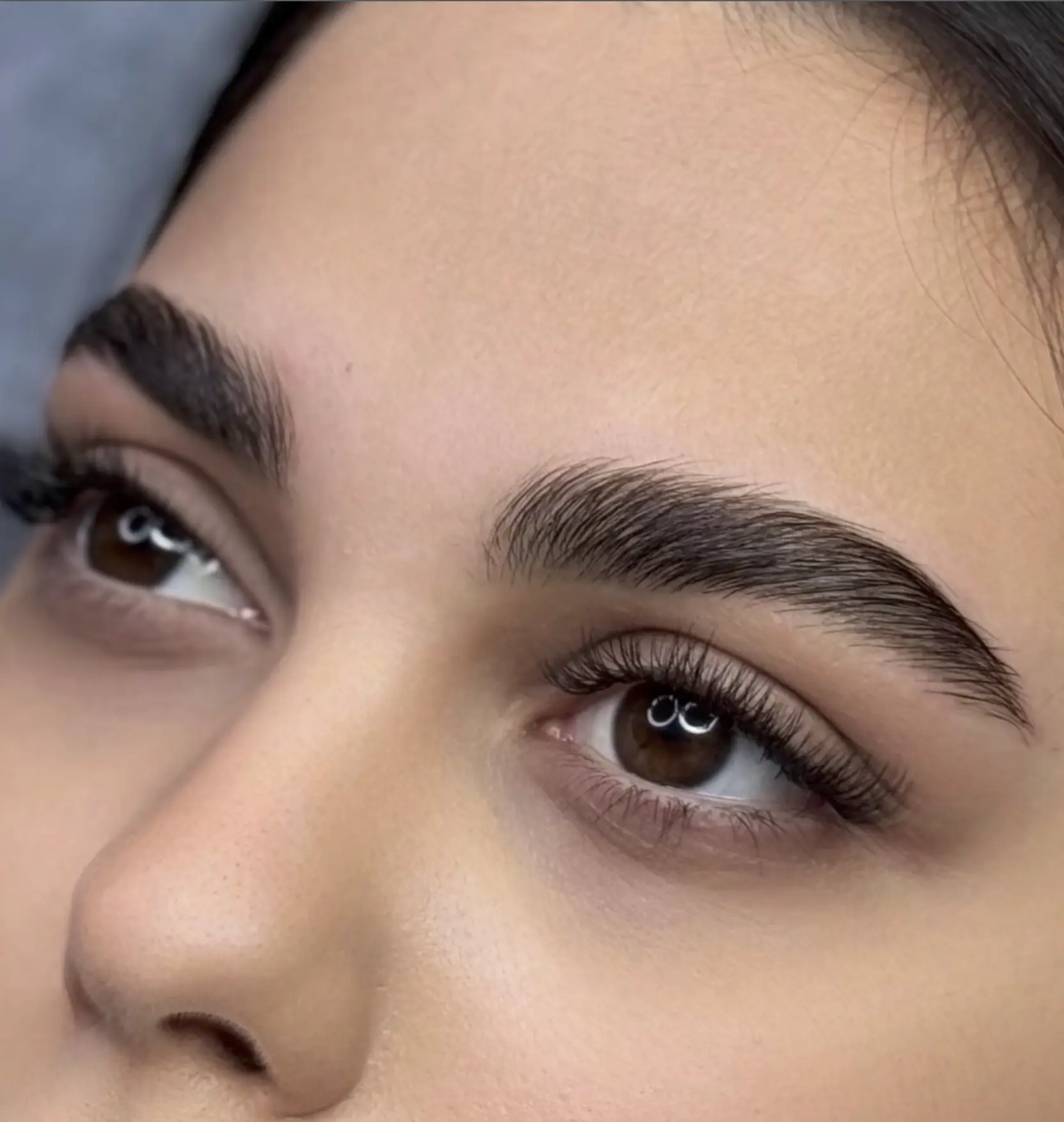 brow lift botox before and after