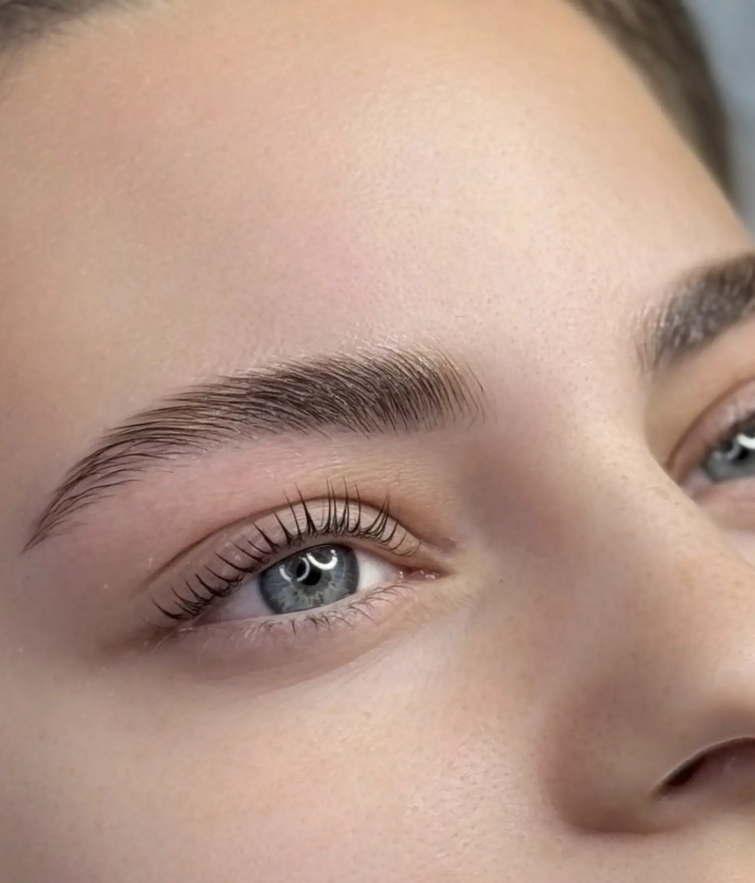 brow lift botox injection points