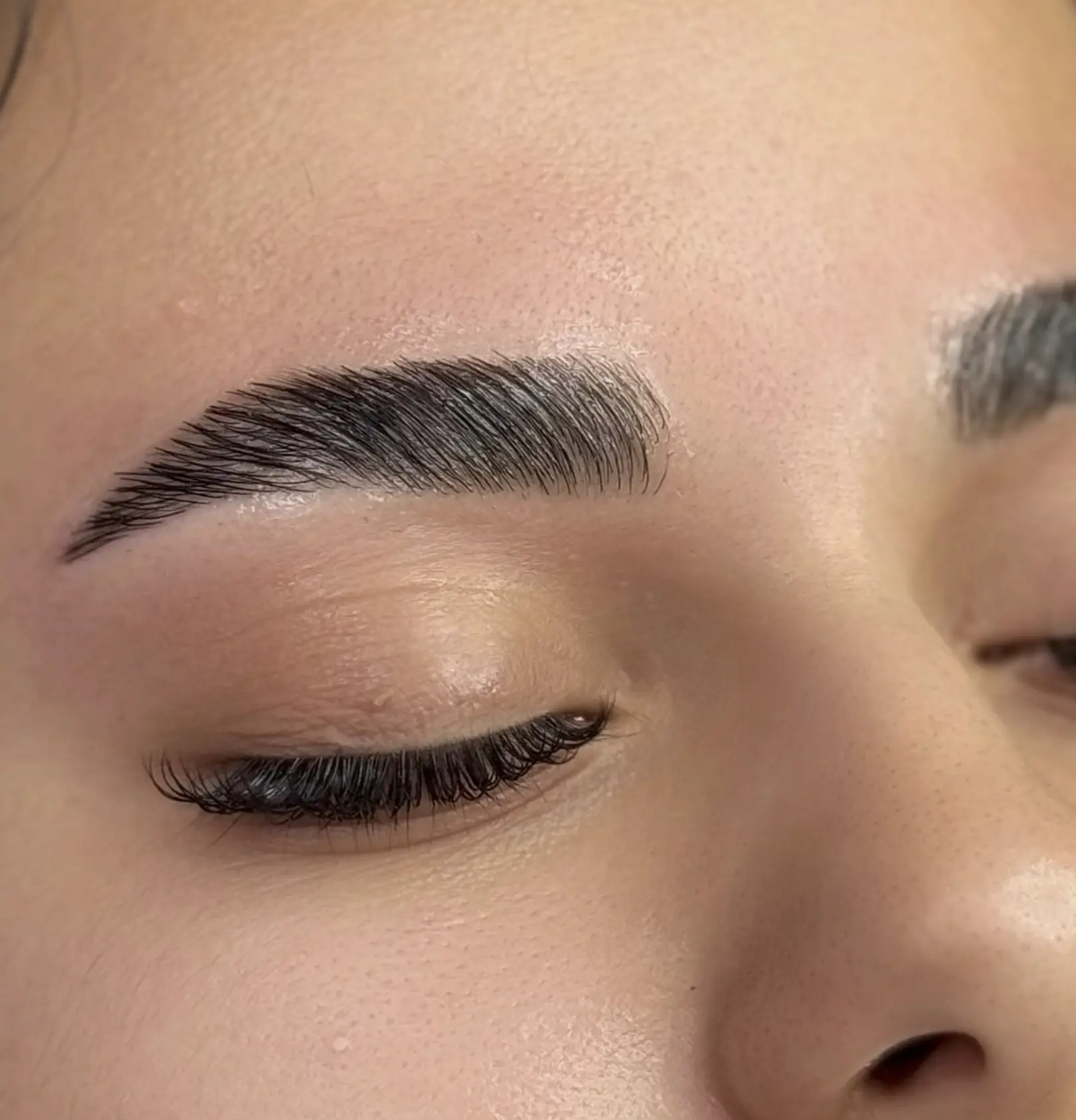brow lift botox melbourne