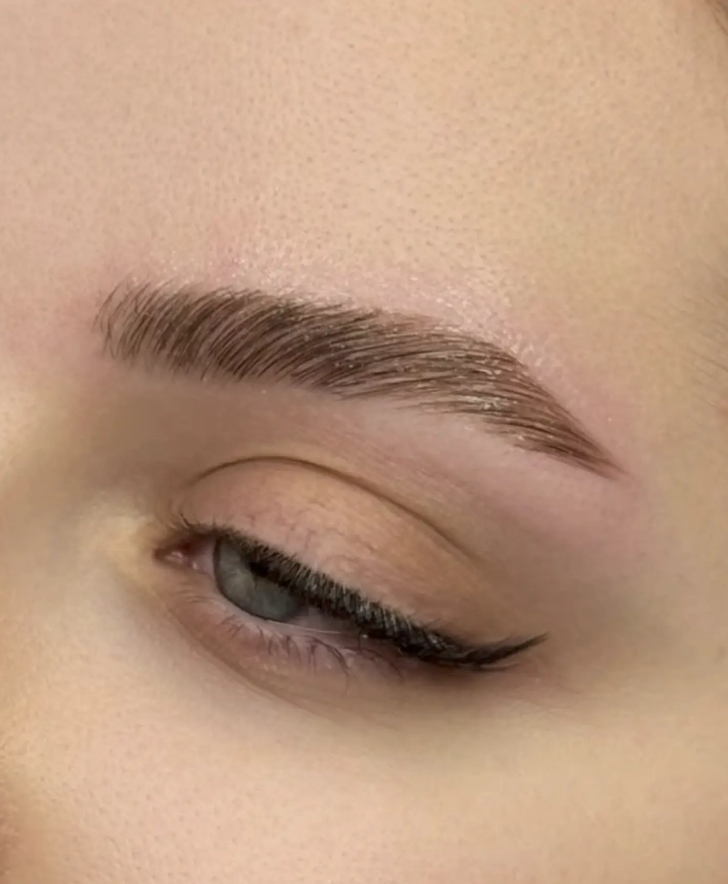 brow lift botox placement