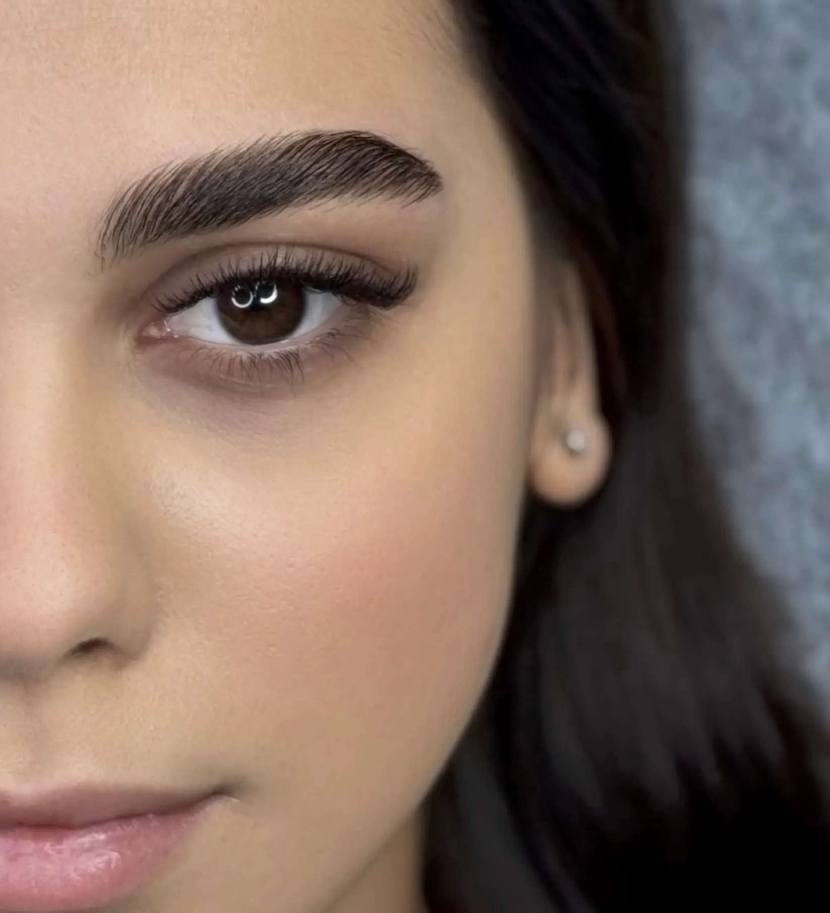 brow lift botox