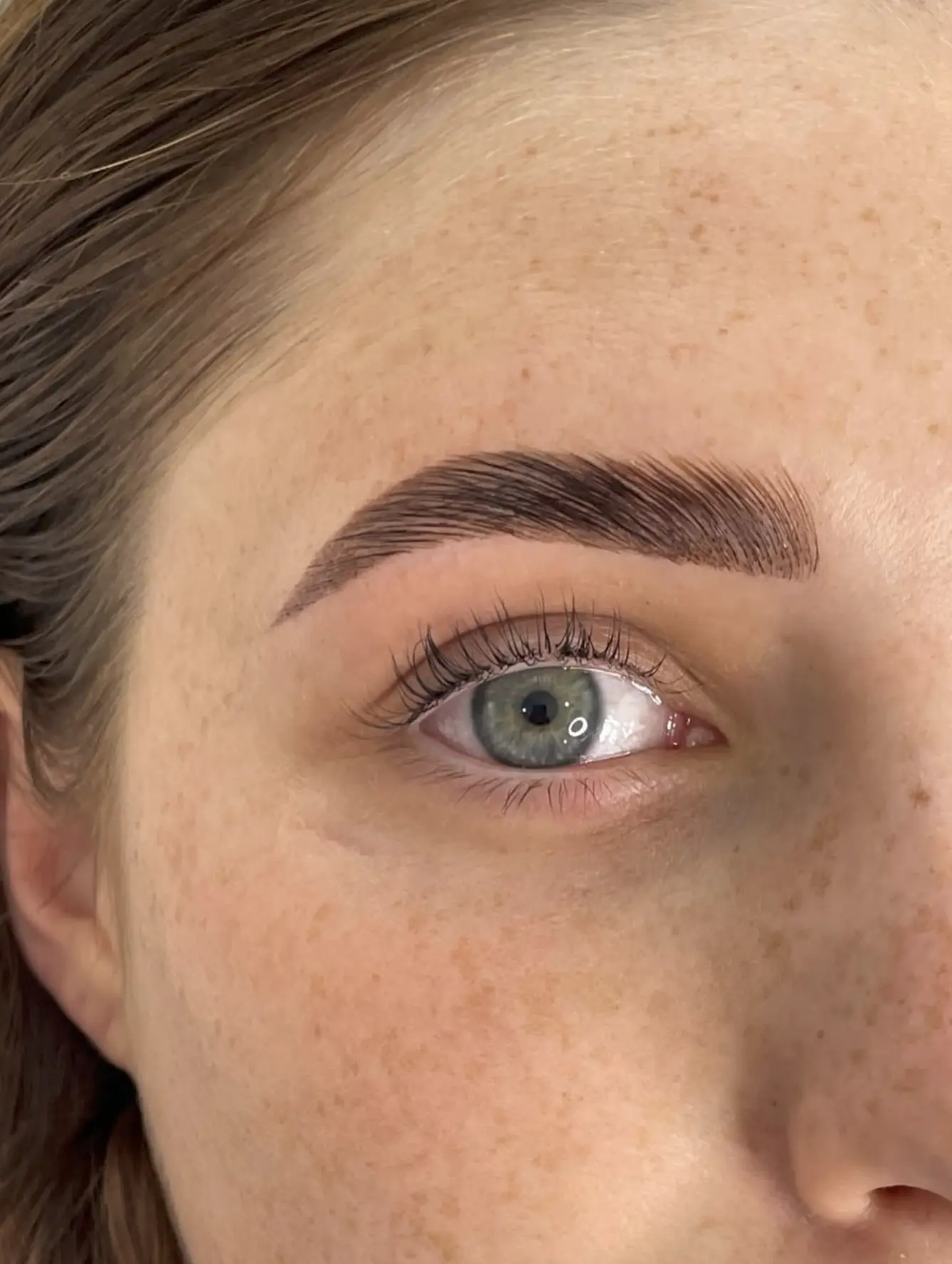 brow lift with botox before and after