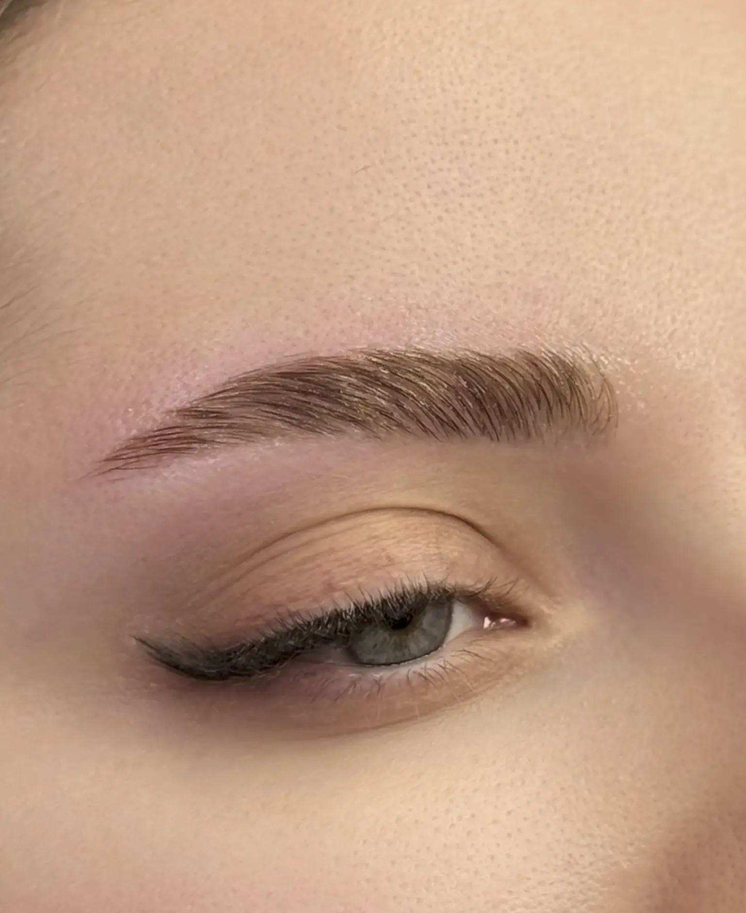 brow ptosis after botox