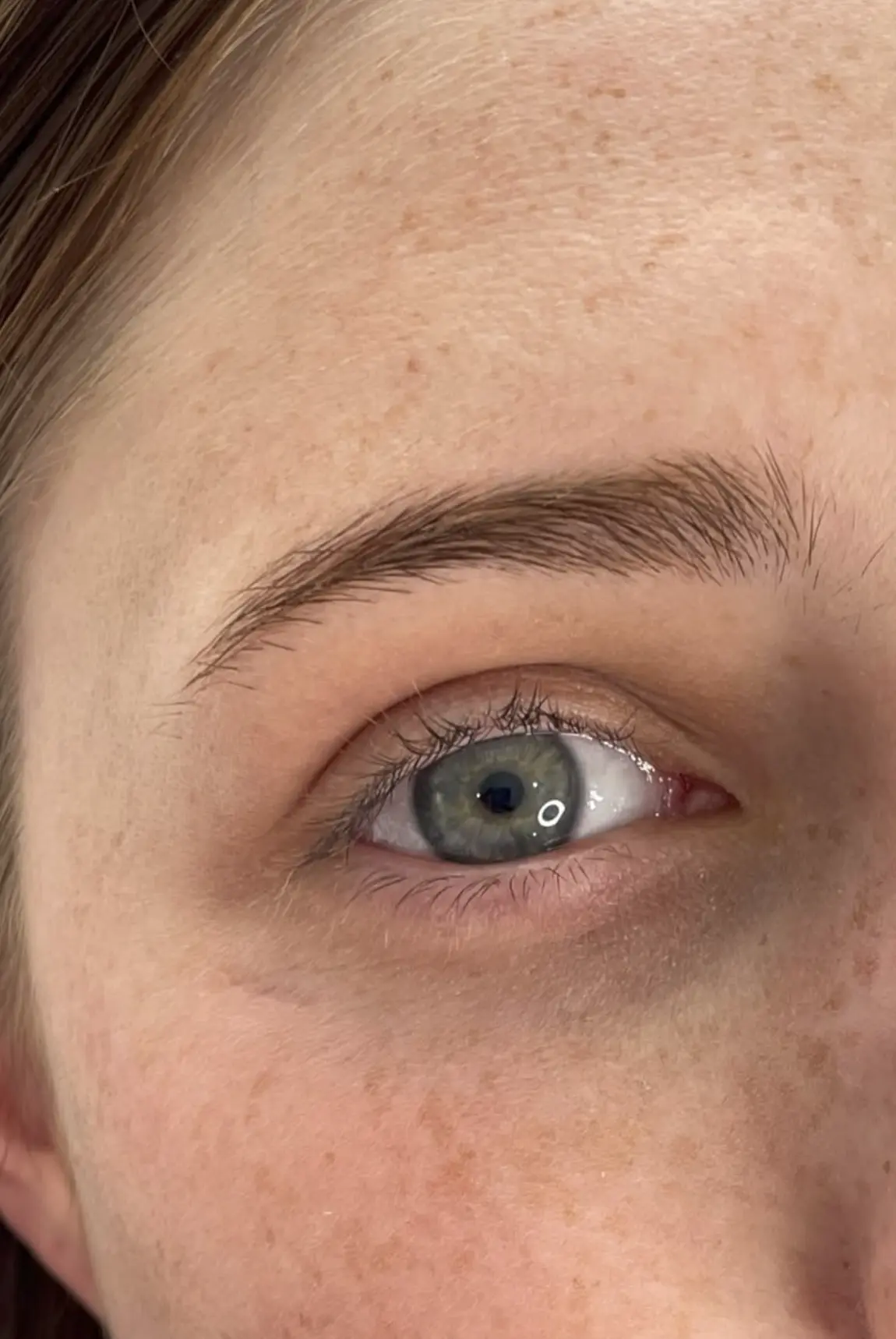 brow ptosis botox