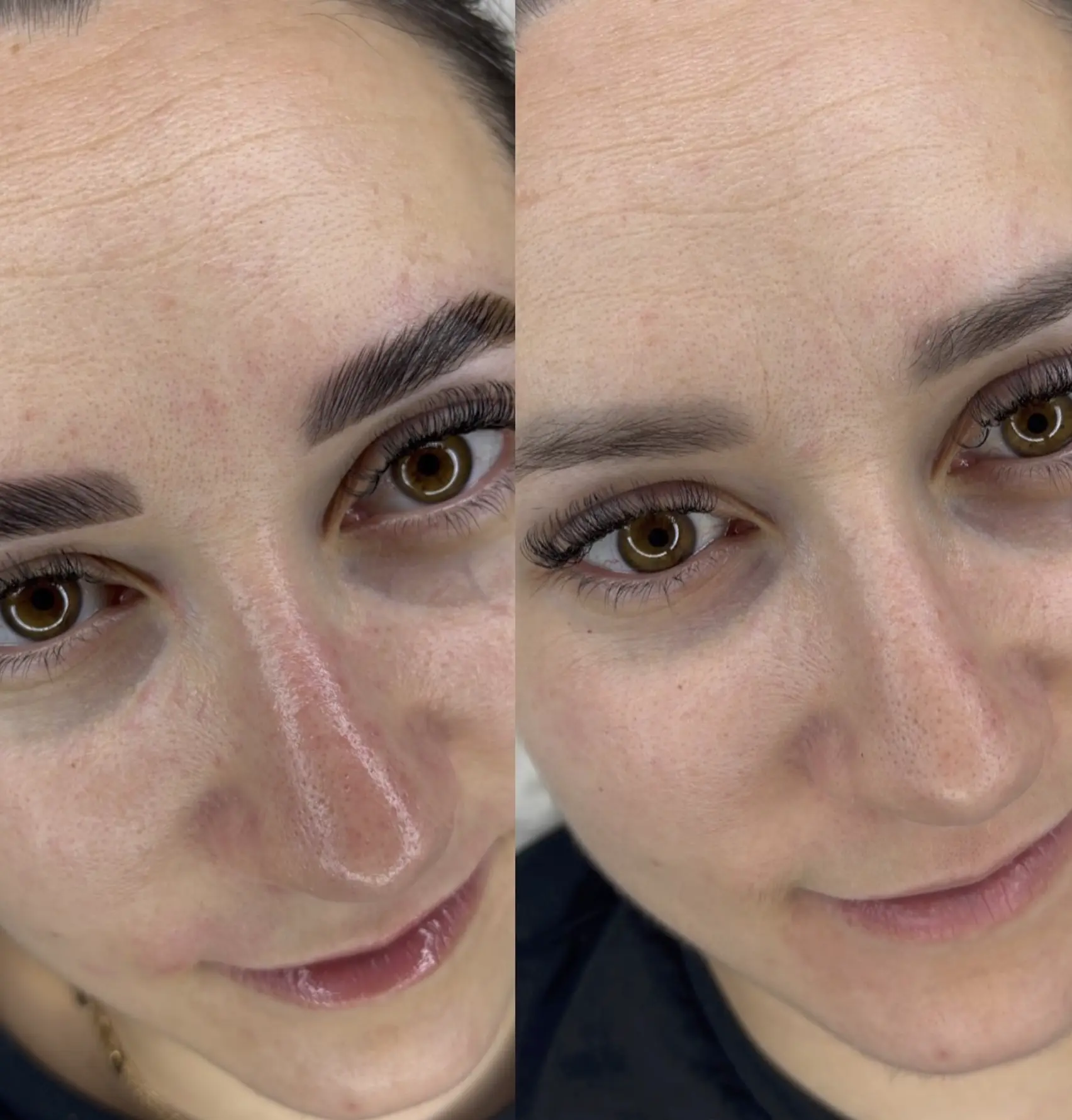 does forehead botox lift eyebrows