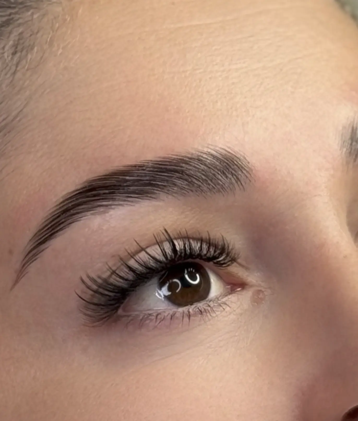 dropped brow botox